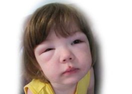 nephrotic syndrome in children