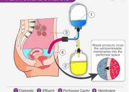 Peritoneal-dialysis2