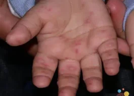 بیماری دست پا دهان